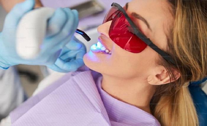 5 Things to Consider Before Getting Your Teeth Whitened Picture2